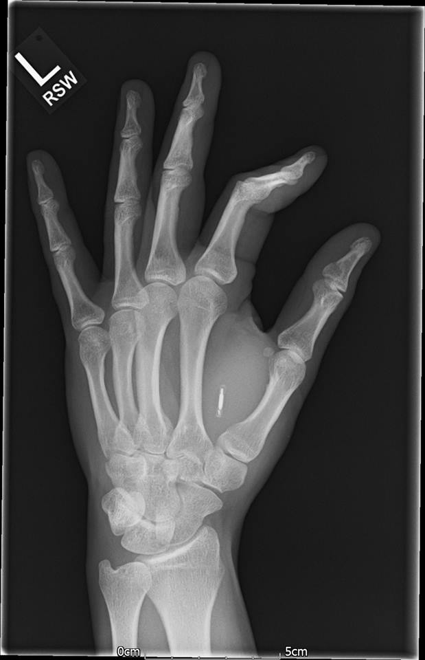BioTeqUK's tweet photo. What an x-ray looks like with one of our implants in! #BioTeq #science #engineering #implants https://t.co/w5E9MigMro