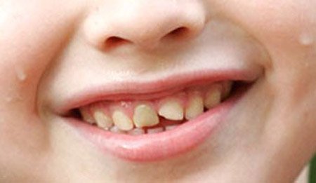 Взрослый человек с молочными зубами. У ребенка сломался молочный зуб. У ребенка сломался молочный зуб. Отколовые зубы у детей. Скол переднего зуба у ребенка.