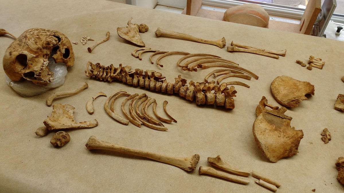 oatweet's tweet image. This 12-13 year old individual has considerable, active nfection affecting the pelvis and sacrum, and may have undergone surgery #dayofarch