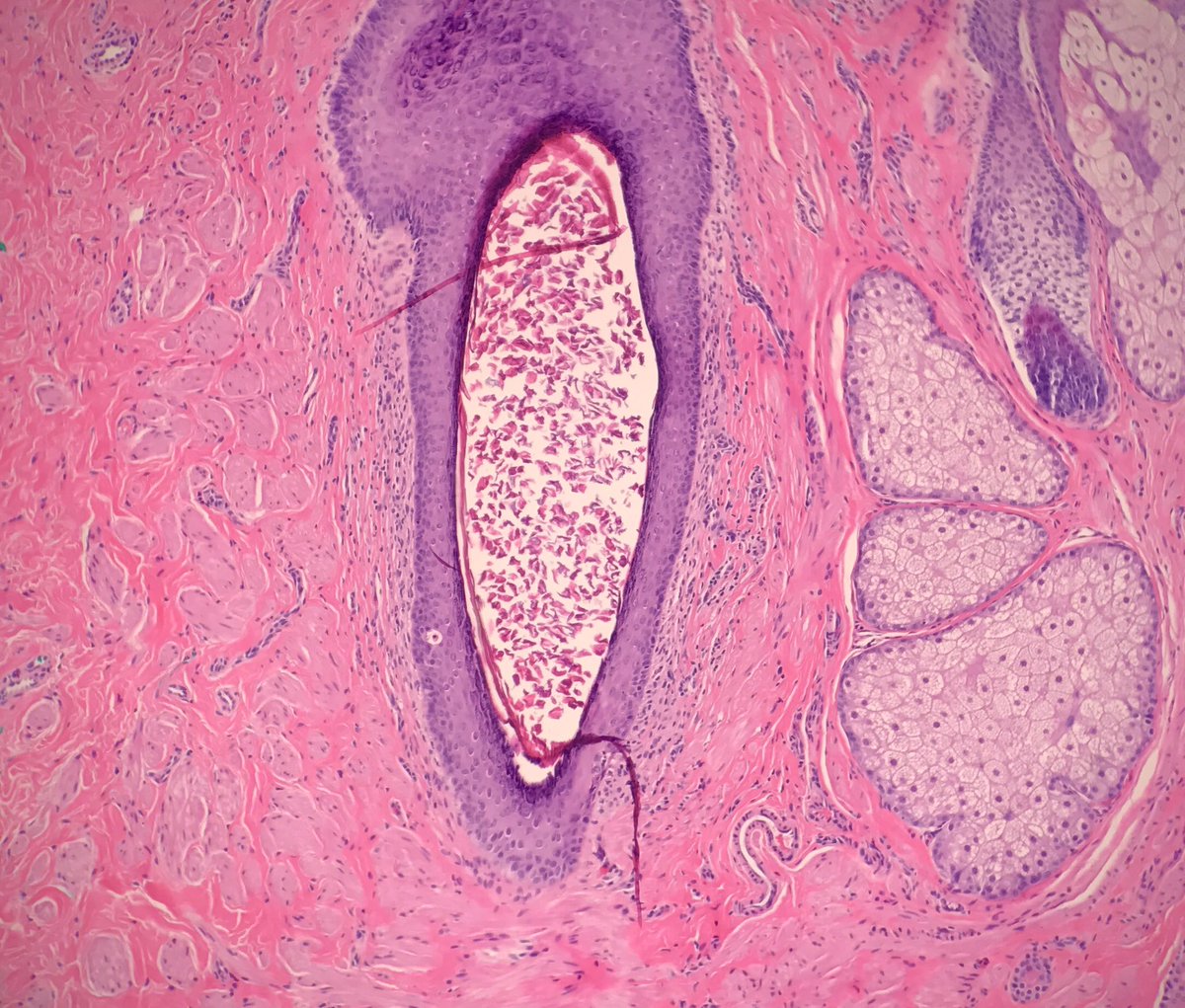 JRamirezMD's tweet photo. Supernumerary nipple: pilosebaceous units, smooth muscle, ducts #dermpath #pathology #dermatology https://t.co/Mnjrj0hkvz