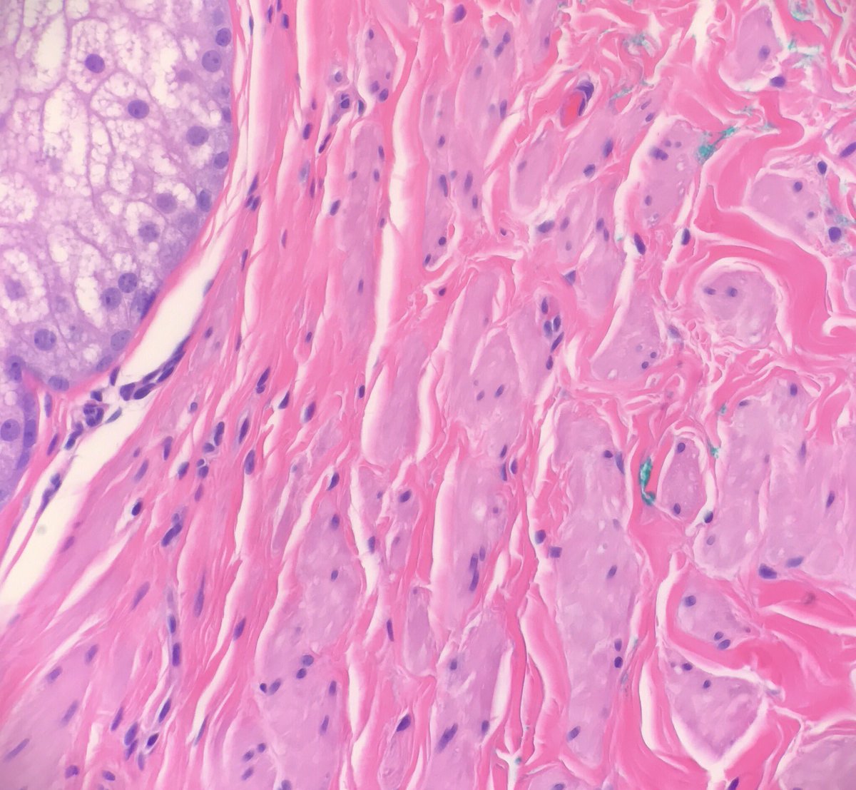 JRamirezMD's tweet photo. Supernumerary nipple: pilosebaceous units, smooth muscle, ducts #dermpath #pathology #dermatology https://t.co/Mnjrj0hkvz