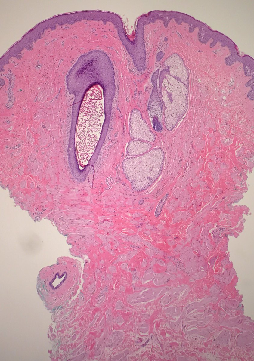 JRamirezMD's tweet photo. Supernumerary nipple: pilosebaceous units, smooth muscle, ducts #dermpath #pathology #dermatology https://t.co/Mnjrj0hkvz