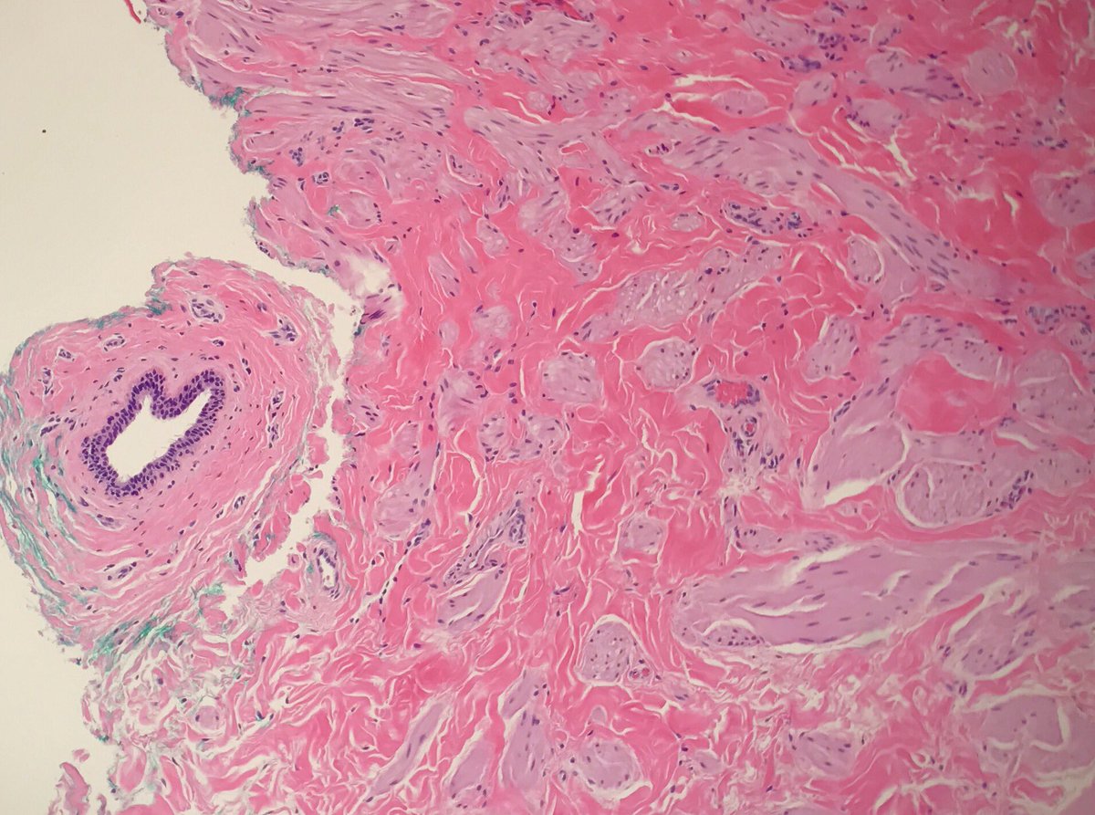 JRamirezMD's tweet photo. Supernumerary nipple: pilosebaceous units, smooth muscle, ducts #dermpath #pathology #dermatology https://t.co/Mnjrj0hkvz