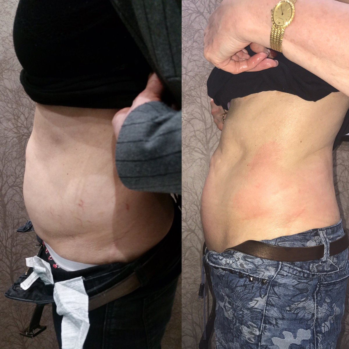 Idealu_London's tweet photo. Mummy Tumms made beautiful again! #Idealu #mummy #btlexiliselite #london #bodysculpting https://t.co/JwQGYf8P0G