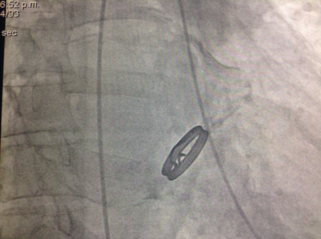 dr_zapataruiz's tweet photo. Calcification of the left atrium in Rheumathic heart disease #porcelain #cocconut https://t.co/5tCrbBzGZr
