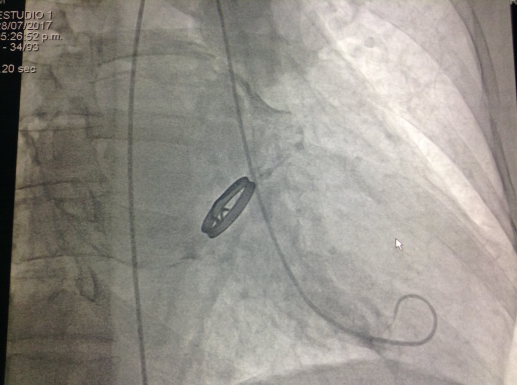 dr_zapataruiz's tweet photo. Calcification of the left atrium in Rheumathic heart disease #porcelain #cocconut https://t.co/5tCrbBzGZr