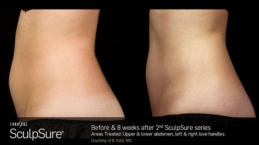 WeighlessMD's tweet photo. A SculpSure Success Story (https://t.co/CtfifSo4AS) #SculpSure https://t.co/bhNVIFMRRG