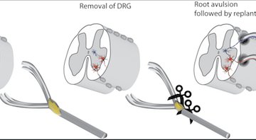LetsFaceItCare's tweet photo. "#New #SurgicalStrategy Offer Hope For Repairing #SpinalInjuries"
https://t.co/CMm9lCSVED
All the #LatestHealthCareNews https://t.co/FGhSXVNuzq