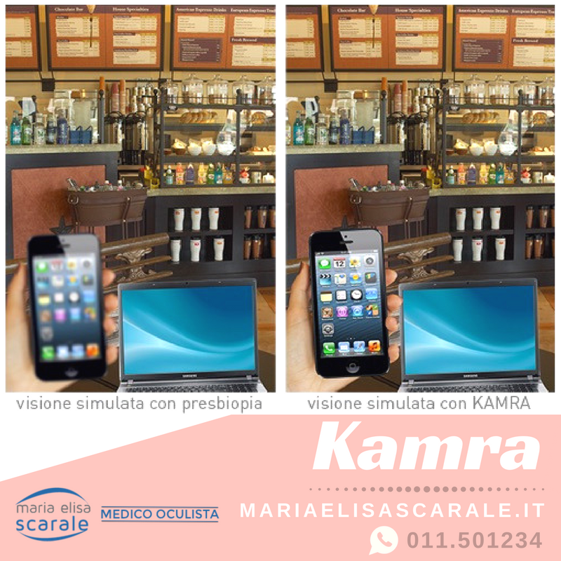 ScaraleOculista's tweet photo. KAMRA™ è una nuova procedura per la correzione della presbiopia.
-
https://t.co/ZYcJ9zS7Kg
-
#presbyopia #eyes #eyecorrection #turin #italy https://t.co/tbS0gfbXmt