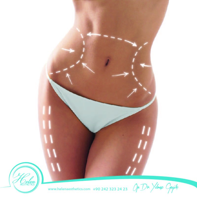 #Liposuction uygulaması sonrasında, 4 hafta süreyle korse kullanılmalı, cildin kendini toparlaması desteklenmelidir.