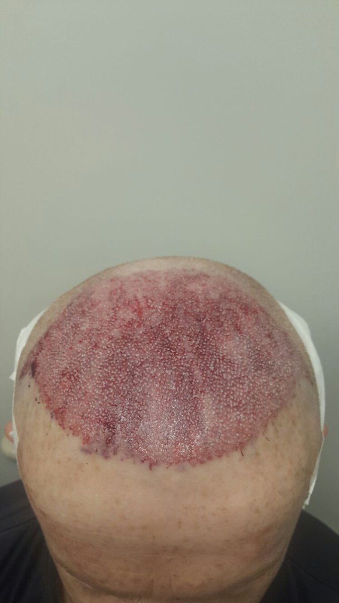 capilCLINIC's tweet photo. Operación de injerto capilar en Turquía con #capilClinic #DrEtoz #Acibadem #trasplanteCapilarTurquía #injertoCapilarTurquía https://t.co/bSR76E6BY5