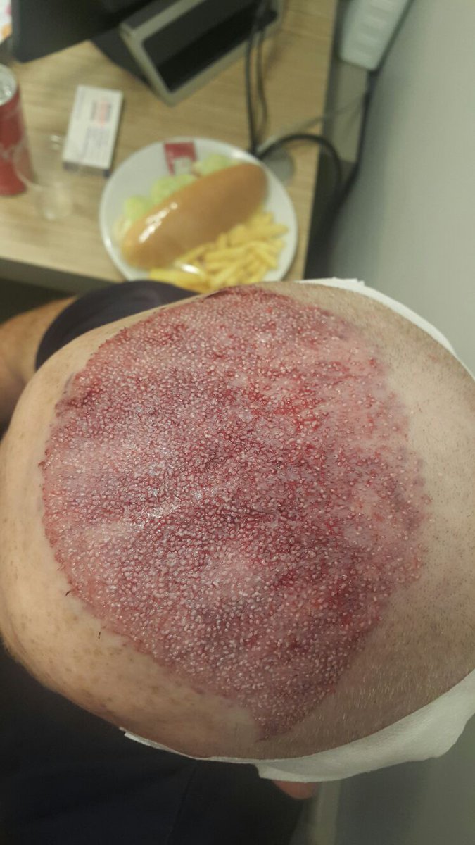capilCLINIC's tweet photo. Operación de injerto capilar en Turquía con #capilClinic #DrEtoz #Acibadem #trasplanteCapilarTurquía #injertoCapilarTurquía https://t.co/bSR76E6BY5