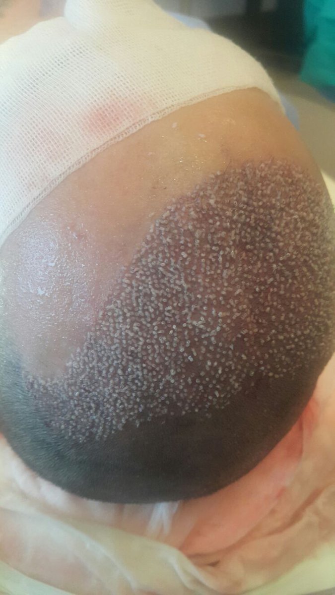 capilCLINIC's tweet photo. Operación de injerto capilar en Turquía 3.000 grafts #capilClinic #DrEtoz #Acibadem #trasplanteCapilarTurquía #injertoCapilarTurquía https://t.co/CCK1VO3FJa