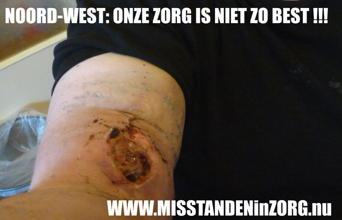 zorgisziek's tweet photo. Wilt u ook een #slagaderlijke #bloeding, daarna na #spoedoperatie, van #IC naar huis worden gestuurd en dan deze #openwond? #Noordwestzkh! https://t.co/ZTmDivTETI