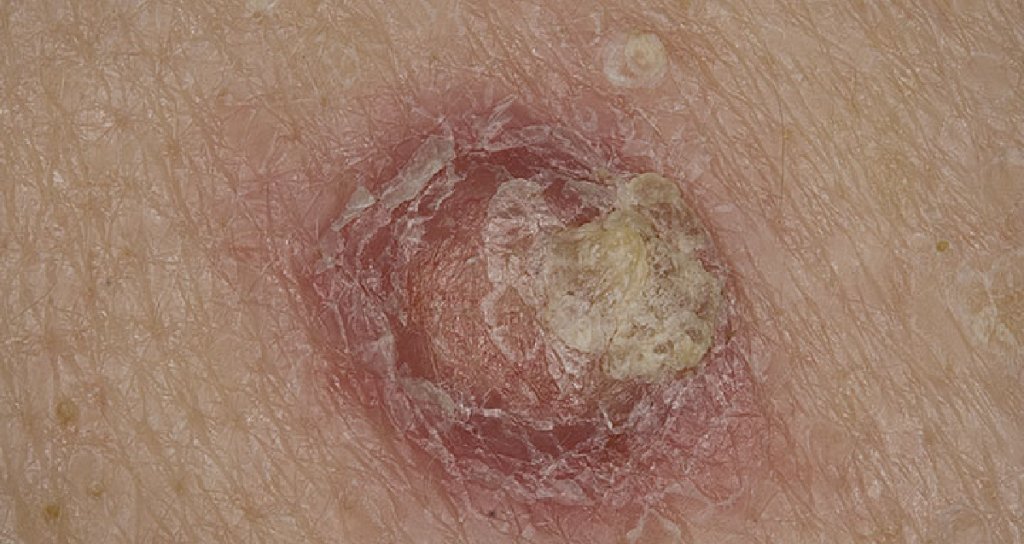WebMD's tweet photo. The warning signs of melanoma don't usually apply to squamous cell carcinoma. What you should know: https://t.co/KDHjHLv1AZ https://t.co/QxJ1C2fwjU