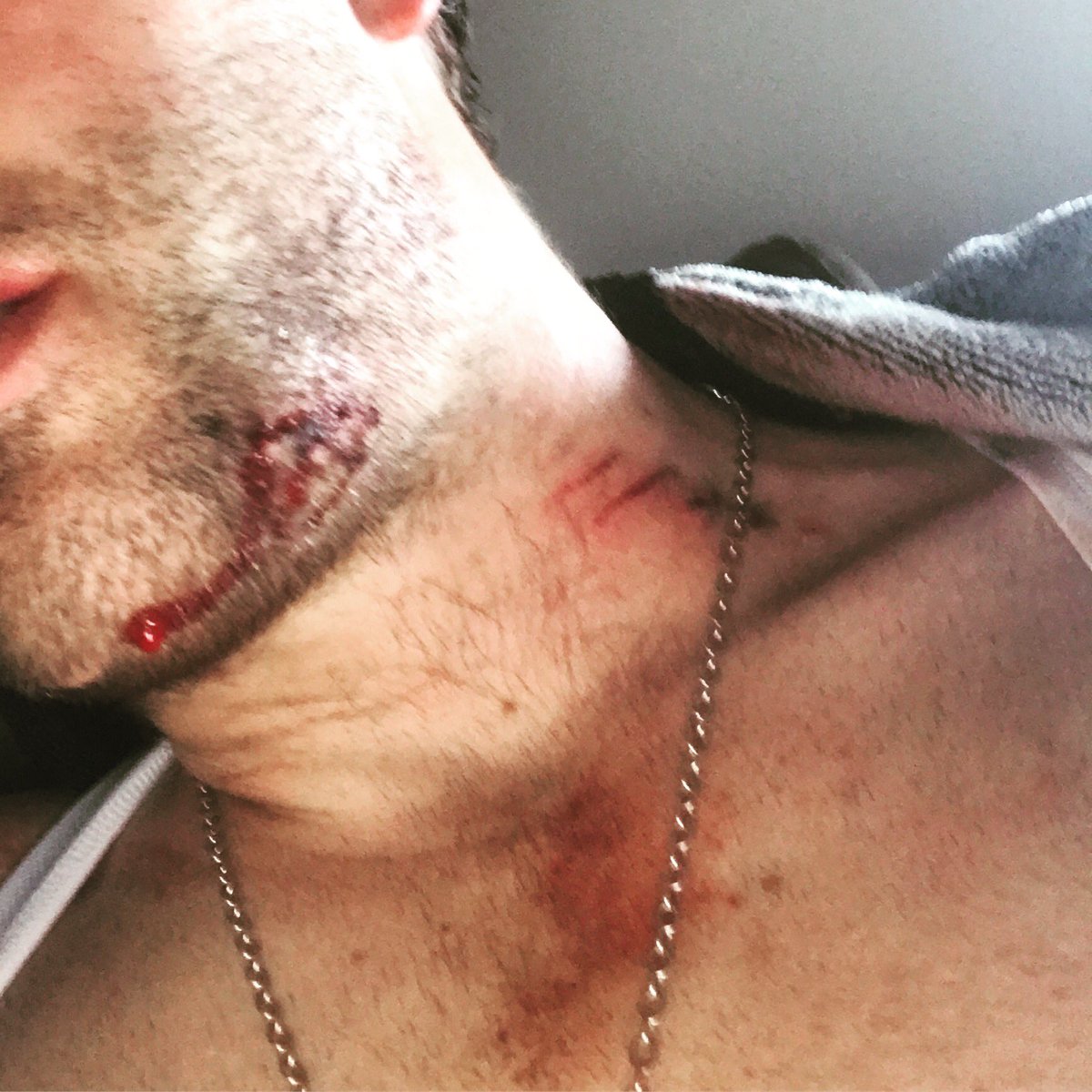 Thumbnail Credit (cyclingnews.com): Less that ideal end to stage one. Campag, shimano or sram spacing anyone? (I'm ok, sore, but ok)