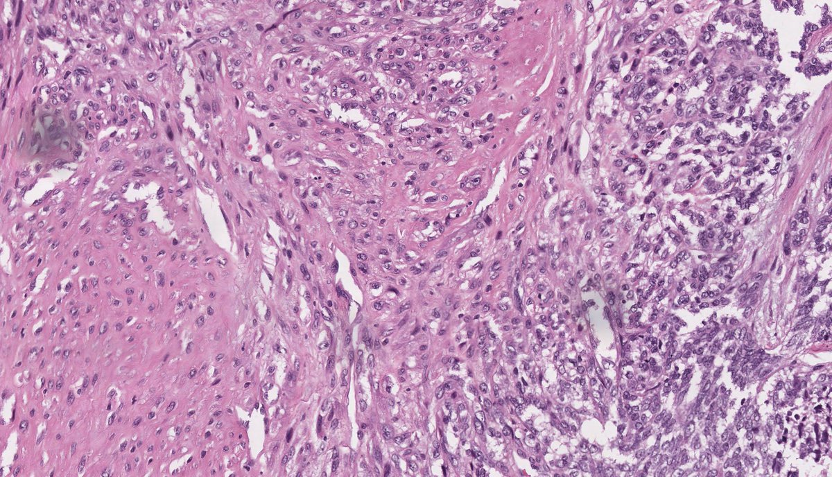 Spindle Epithelial Tumor with Thymus-Like Differentiation (SETTLE) #pathology #pathologists #histopath #histology