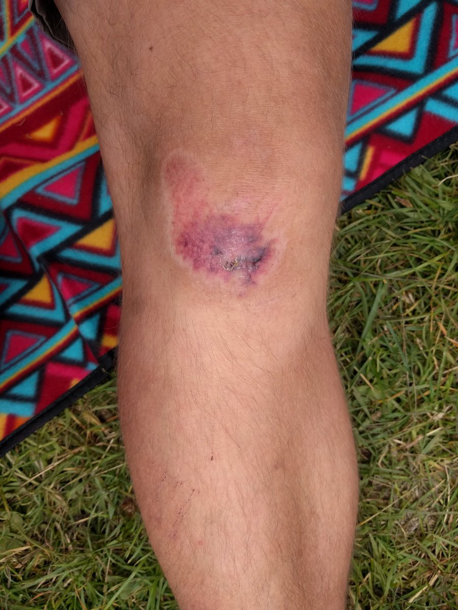 dvlrnr's tweet photo. Hopefully my knee won't object to my return to #cycling tomorrow. Been off the bike since June 17. #Maanteekarikasari #Pandivere #rattasõit https://t.co/bNfkxtXr0I