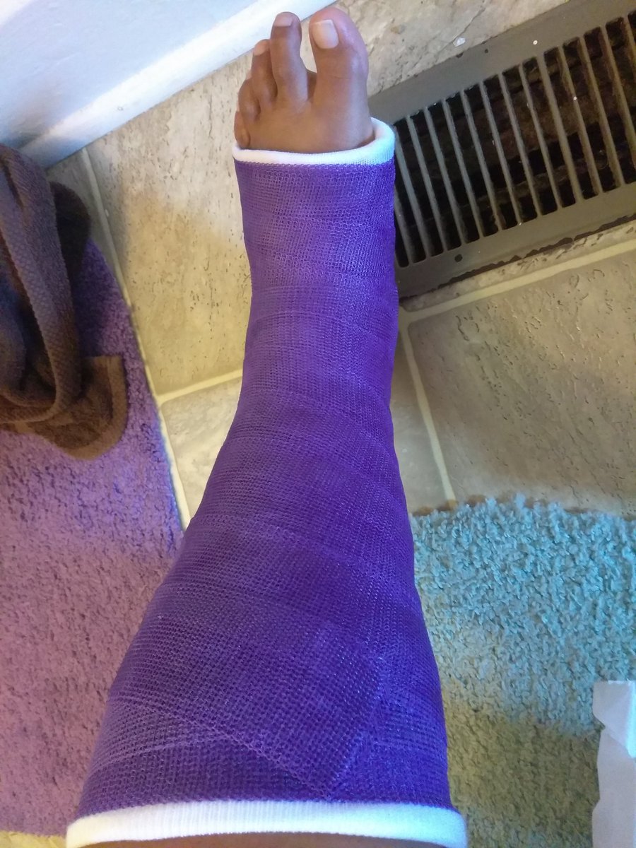 nittis1's tweet photo. Fibula broken and ankle messed up. Won't stop me!! #loving50 #spoiledqueen #itsallaboutme #supermom https://t.co/hRdcFx0Scn
