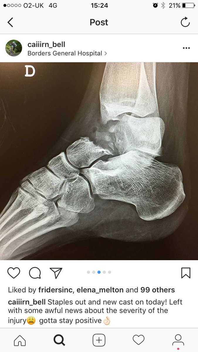 This season the <a href="/female_riders/">Female Riders</a> race team has witnessed how hard #mountainbiking can be on the body. Two riders down we still have 3.