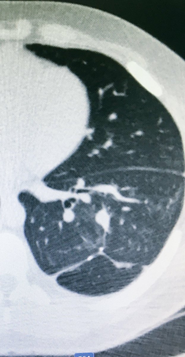 fermgmez's tweet photo. #XPerGuide & #XPerCT, oblique access to treat 2 lung lesions in a single insertion @PhilipsHealth @PhilipsSpain https://t.co/PcctBjGf4N