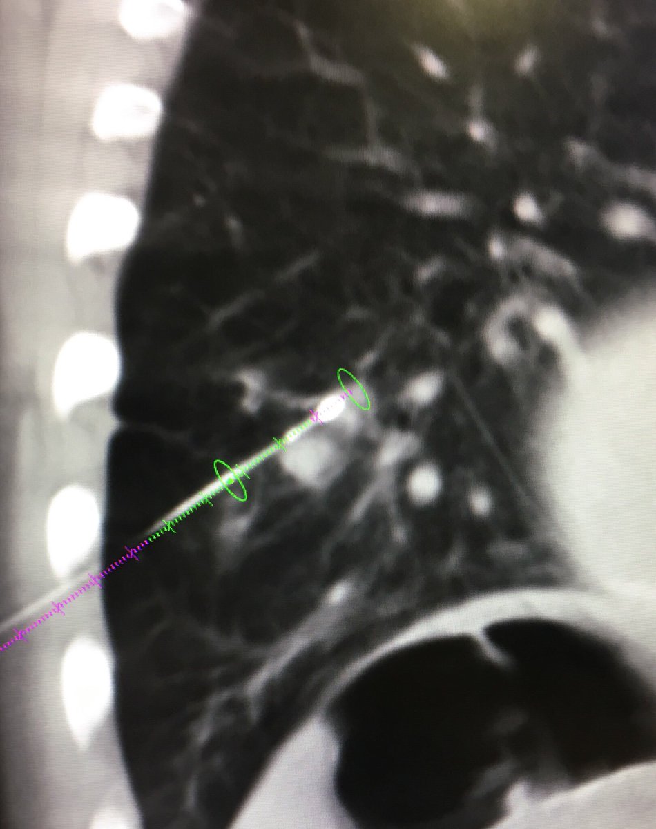 fermgmez's tweet photo. #XPerGuide & #XPerCT, oblique access to treat 2 lung lesions in a single insertion @PhilipsHealth @PhilipsSpain https://t.co/PcctBjGf4N