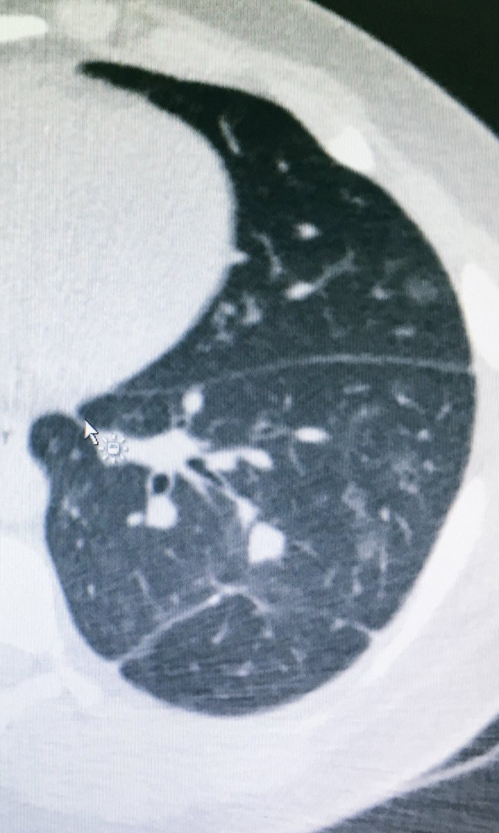 fermgmez's tweet photo. #XPerGuide & #XPerCT, oblique access to treat 2 lung lesions in a single insertion @PhilipsHealth @PhilipsSpain https://t.co/PcctBjGf4N