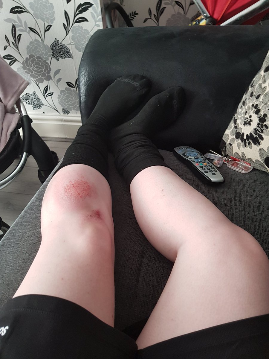 hardmant1's tweet photo. Really enjoyed today with @TheRegendaGroup girls now at home resting my groin and my injured leg #WADAC2017 https://t.co/L3vOVi00Y3