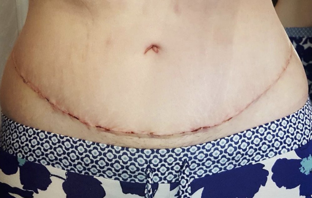 WomensHealthMag's tweet photo. 8 things you should know about tummy tucks–from someone who got one:
https://t.co/acLOneHTgM https://t.co/RhIiJEU1zZ