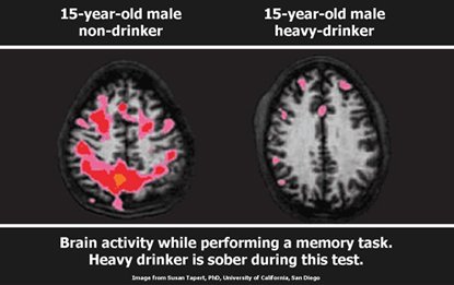 TheBrainClinic's tweet photo. Heavy drinking during adolescence: Dire effects on the brain
https://t.co/vDATZRxzBF https://t.co/pz1dw9FRrQ