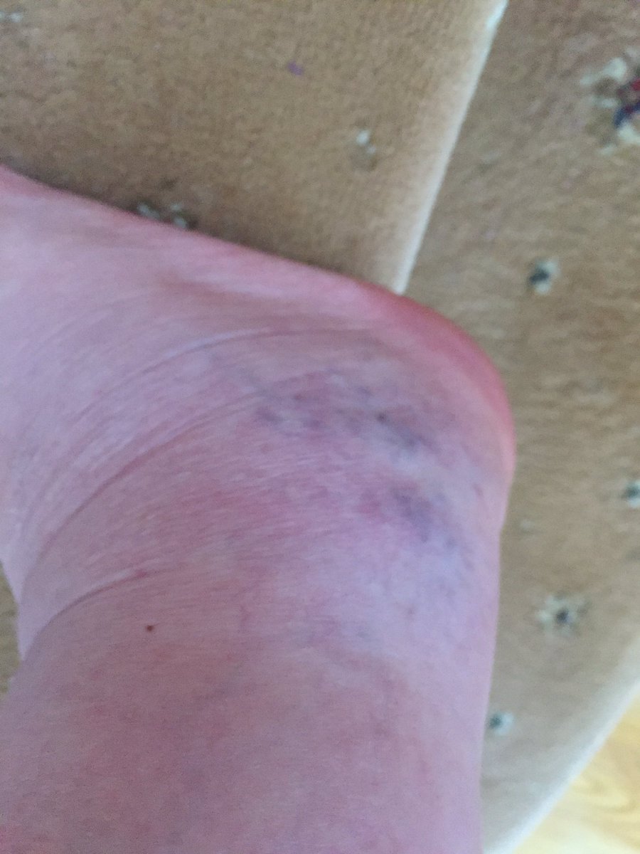 valarieoleary's tweet photo. Hi Tweeps, Sorry, Haven't Been Very Active last Few Days, Just Catching Up Now, Here's My Reason Why ,Yes, I Smashed Me Ankle #butimfine . https://t.co/YzsUEPnv2h