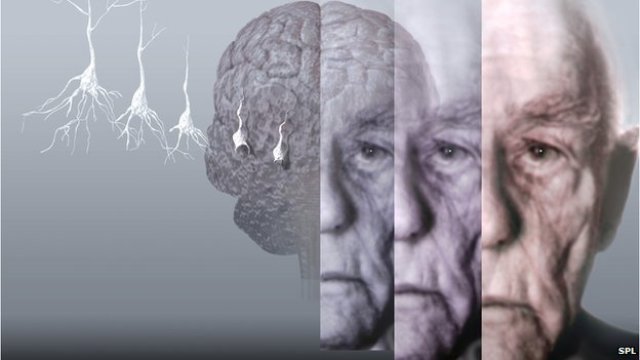 TheBrainClinic's tweet photo. New Discovery in Motor Neuron Disease and Dementia Could Pave the Way For New Treatments  https://t.co/xgoV9Yb2w6 #sciencedaily #brainclinic https://t.co/I2IhngaGxq