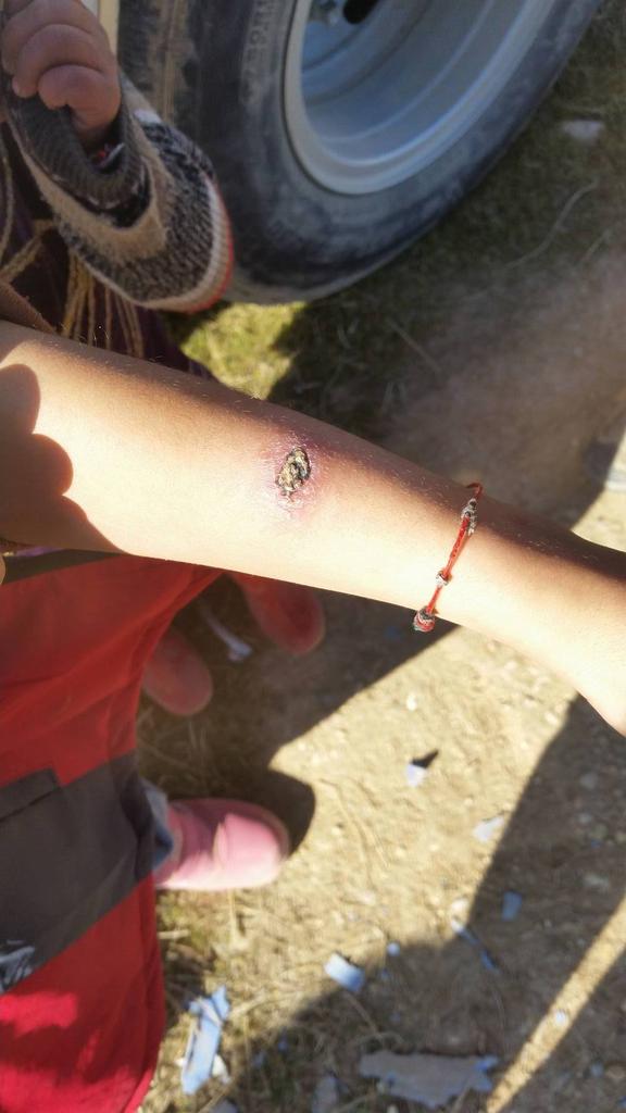 YAWorganization's tweet photo. 2) Last yr there were over 700 people infected with leishmaniasis in #Sinjar. https://t.co/ifkPKdr34K