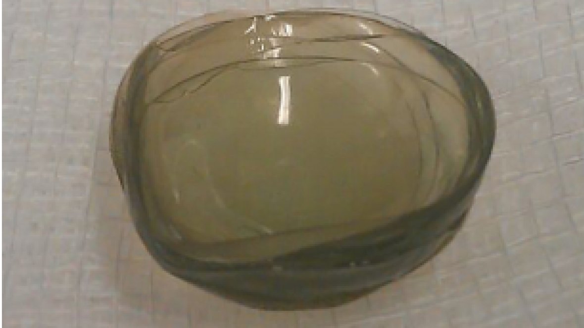 CBCNews's tweet image. British surgeons removed a congealed mass of 17 contact lenses from behind a patient&apos;s eye — and then found 10 more. cbc.ca/1.4210266