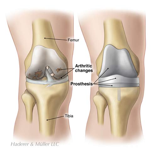 OrthoKnox1's tweet photo. Learn more about knee #arthritis and when #kneearthroplasty or #kneereplacement may be recommended: https://t.co/6suOhEIDpf https://t.co/Jrauw7VtAJ
