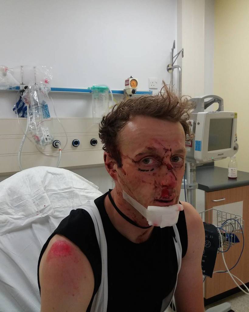 so my modelling career has taken a minor set back...... #TakeItOnTheChin #FacePlant ift.tt/2tcucLT