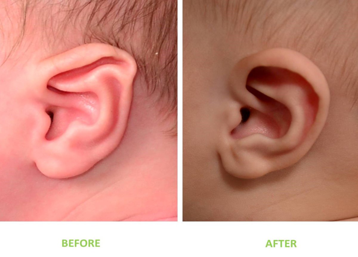 ArtisanSurgery's tweet photo. Baby ears on  #TransformationTuesday.  This newborn patient of Dr. Fishman's underwent non-surgical ear correction with #Earwell. https://t.co/BTl4MzlDWe