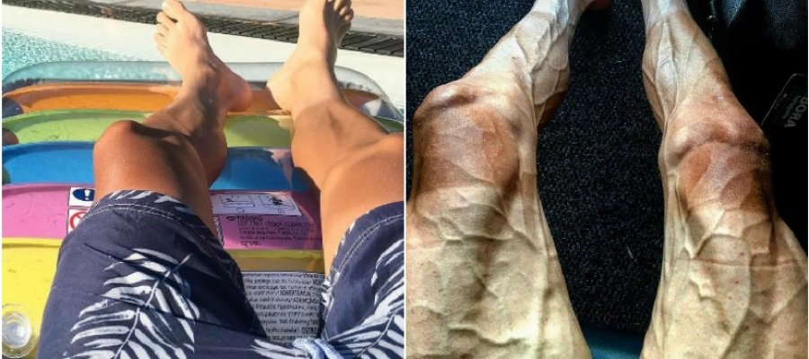 A3Noticias's tweet photo. ¡Asusta! El contraste de las piernas de un ciclista durante sus vacaciones y tras la 16ª etapa del #TDF2017 https://t.co/IKO8ABlrRO https://t.co/Giqpb8k83J