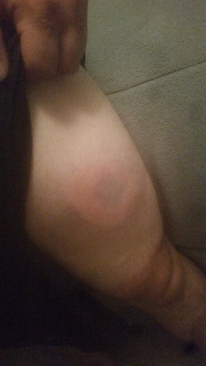 RondiazS's tweet photo. @HunterMartineau took a nice line drive to the thigh while pitching tonight! Still made the play! That's @RONDIAZRum worthy! #RonStrong #tan https://t.co/4Hb222rEyS