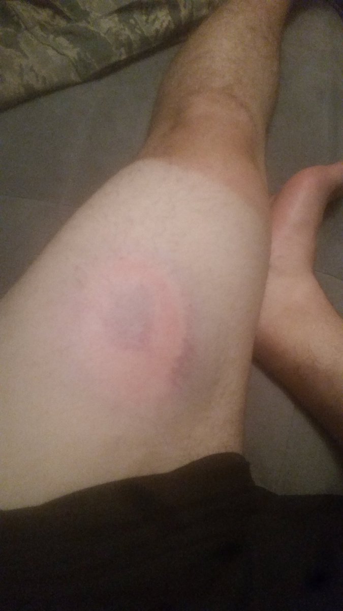 RondiazS's tweet photo. @HunterMartineau took a nice line drive to the thigh while pitching tonight! Still made the play! That's @RONDIAZRum worthy! #RonStrong #tan https://t.co/4Hb222rEyS