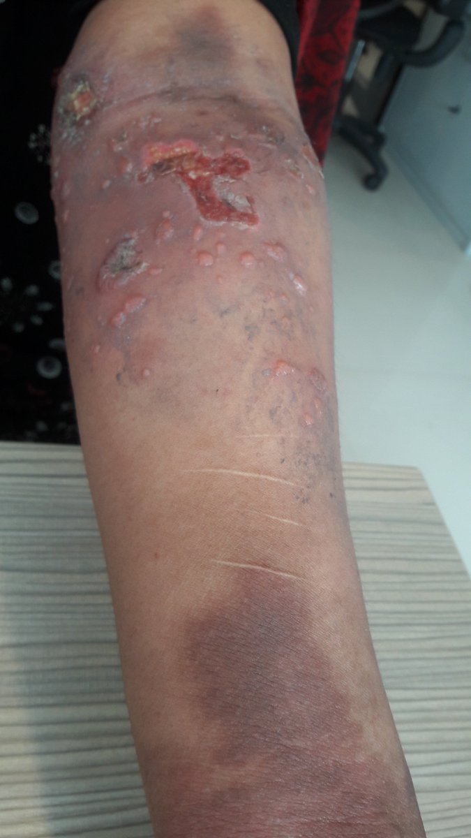 theDermatologis's tweet photo. Radiocontrast dye extavasation injury. Ignored since 5 days. Now superficial phlebilitis in Doppler. #ContrastCT #Skinnecrosis https://t.co/lLIuQtzSQ6