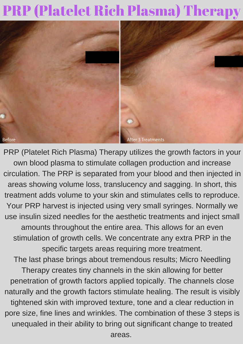 Anti_Aging_FL's tweet photo. #BrazeliaMedSpa is pleased to offer you this cutting edge #services. Contact us today to set up your appointment with us. 561-353-2265 https://t.co/u8ZU5idF13