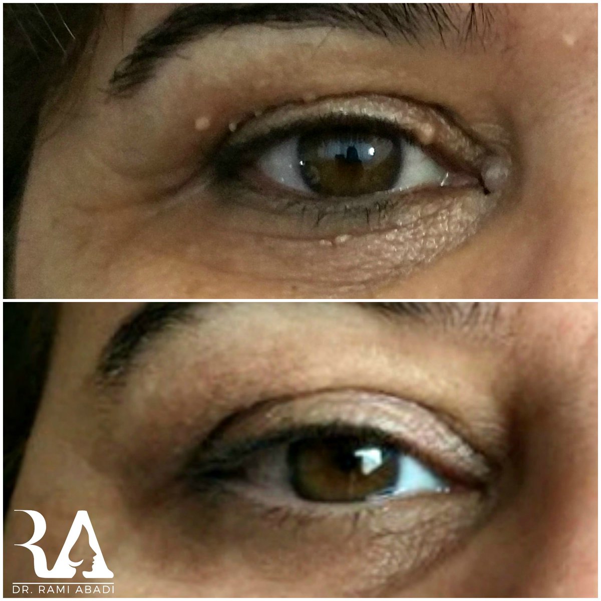 Dr_RamiAbadi's tweet photo. Skin tags removal is fast, painless and won't scar the #skin.
 
 #skintag #milia #skinflap #skincare #dermatology #dermatologist https://t.co/Cdne6jauni