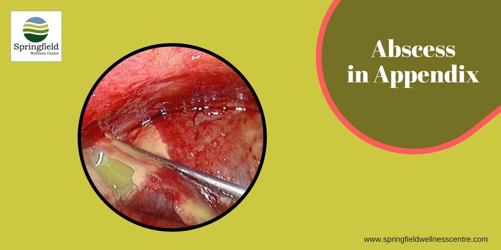 drmaran's tweet photo. One complication of a burst #appendix is the formation of #abscess. Know more here. https://t.co/gzJO8wSrPO #AppendixRemoval #DrMaran https://t.co/hFhnMrKMQS