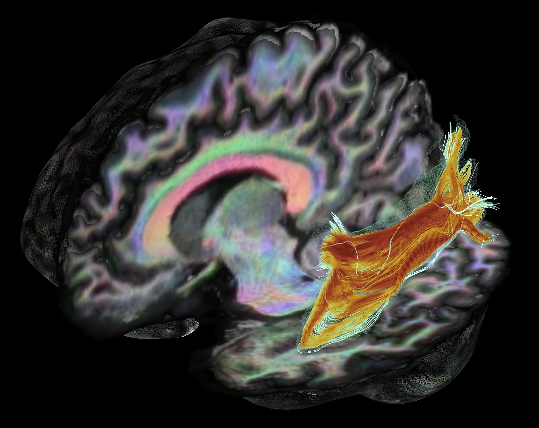 MaxChamb's tweet photo. Well that's loop.
#Tractography #FiberNavigator
#nofilter https://t.co/CtXsGXoOTa