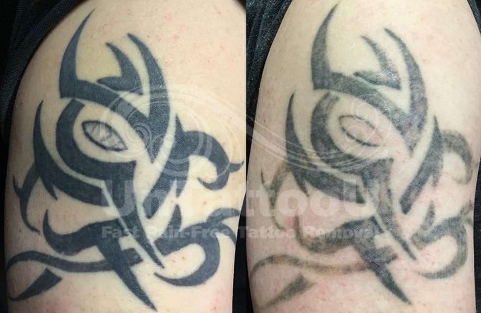 Tattoo Removal: How It Works, Process, Healing & Scarring
