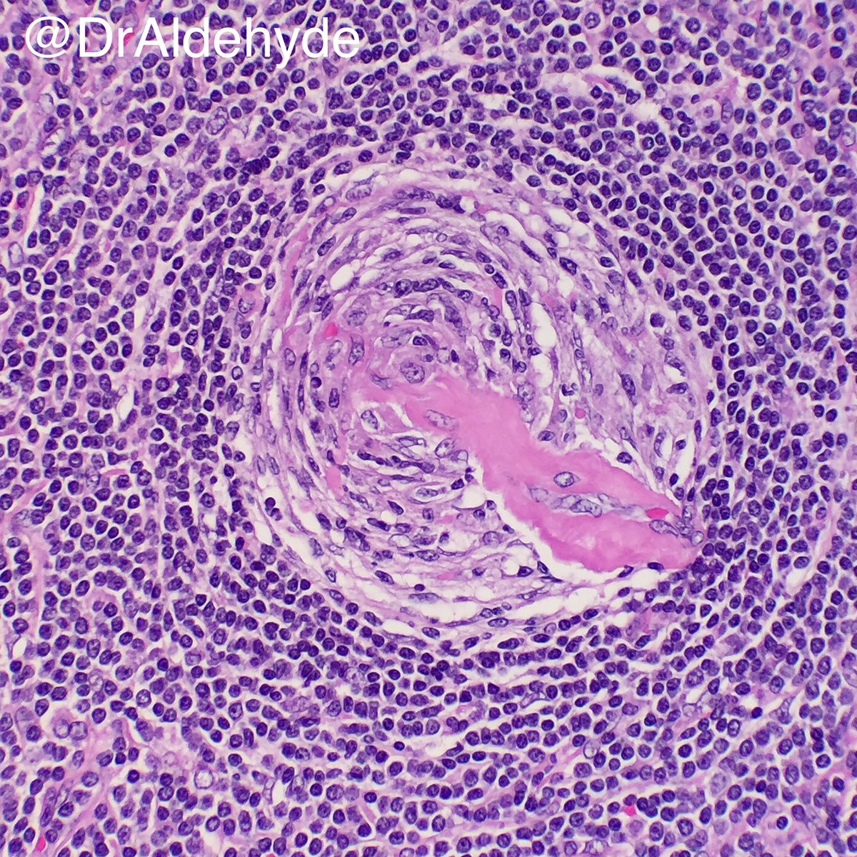 DrAldehyde's tweet photo. Castleman's disease (hyaline vascular type) = onion skin + lollipop πππ₯π₯π¬π€£ #hemepath #hartfordpath #castlemansdisease #onionskin #lollipop https://t.co/iGQ3o4Yhhi