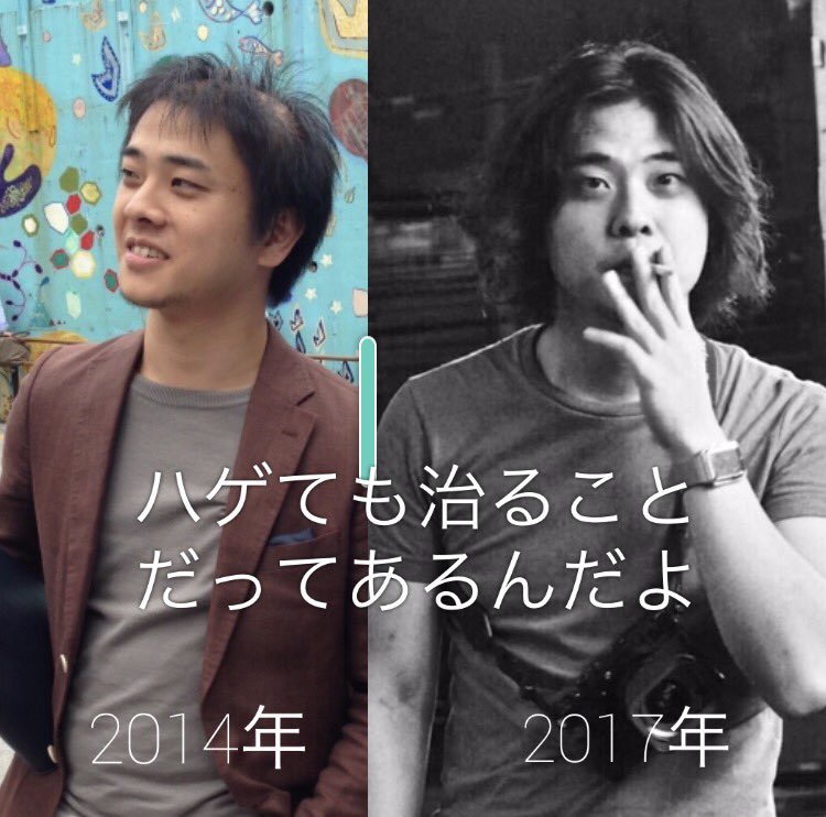 北澤晋太郎 奥能登スズで子育て中 Twitterissa 最近いきなりハゲてきた方 諦めないで下さい このように一度は散らかした髪の毛が戻ってくる場合もあります 皮膚科医も原因も分からず匙を投げつつあったハゲでしたが放っておいたら復活しました ハゲ このハゲー 北澤晋太郎 奥能登スズで子育て中 Twitterissa 最近いきなりハゲてきた方 諦めないで下さい このように一度は散らかした髪の毛が戻ってくる場合もあります 皮膚科医も原因も分からず匙を投げつつあったハゲでしたが放っておいたら復活しました ハゲ このハゲー