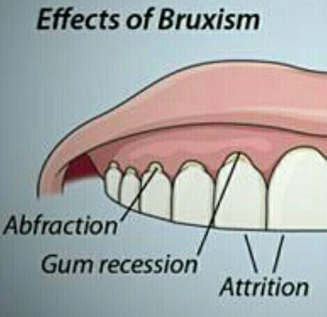 Do u grind teeth? 😬

See if you have these signs...