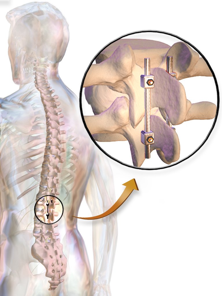 lyfboat's tweet image. Details on Spinal Fusion Surgery in India:

goo.gl/PLt4bQ

#Lyfboat #Spinal_Fusion